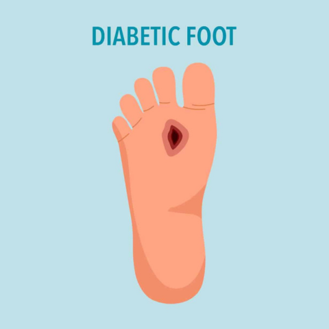 What is Diabetic Foot?